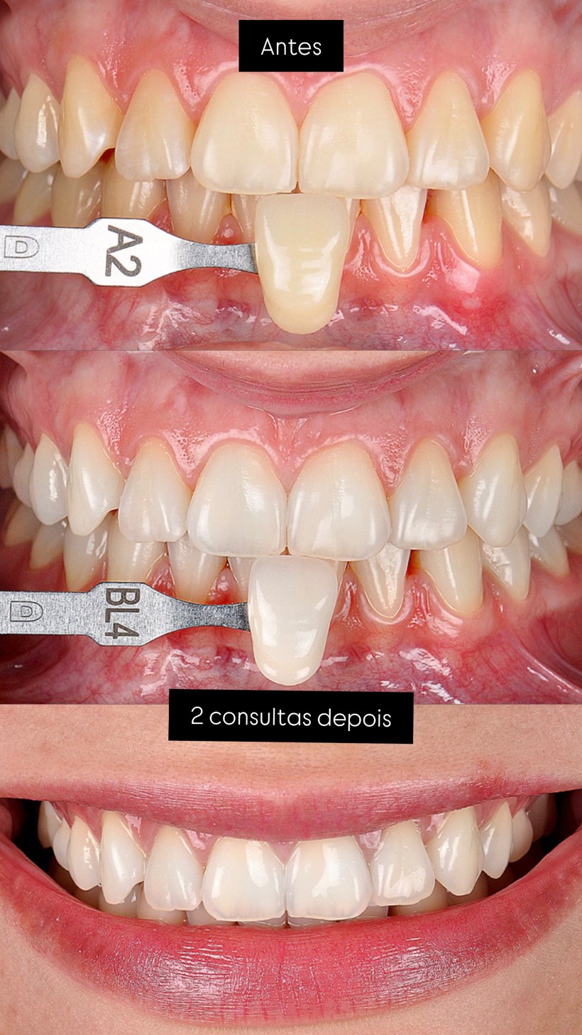 Antes e depois — clareamento em 2 consultas